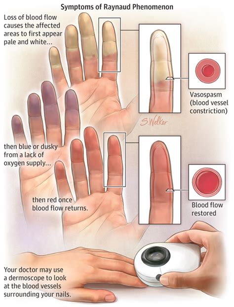 Enfermedad De Raynaud