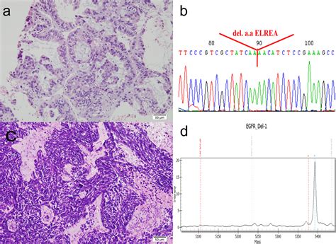 Frontiers Extensive Stage Small Cell Carcinoma Transformation From