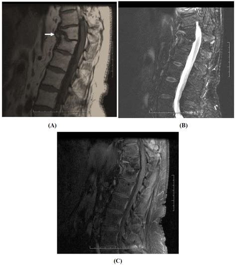 Two New Cases Of Symptomatic Discal Calcifications In Adults