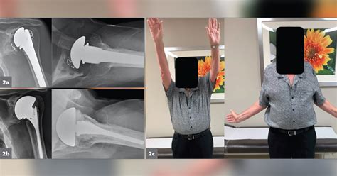 Functional Antibiotic Spacer Can Be Used To Treat Shoulder Prosthetic