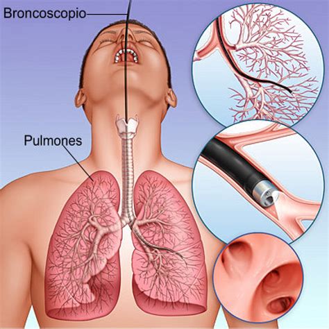 Biopsia Pulmonar Quir Rgica Para Establece Un Diagn Stico