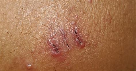 Stitches Removal Rash Irritation Album On Imgur