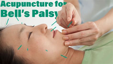 Acupuncture For Bell S Palsy Han S Chiropractic And Acupuncture Palatine