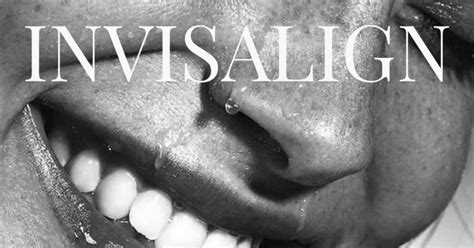 Ventajas De La Ortodoncia Invisible Lora Boutique Dental