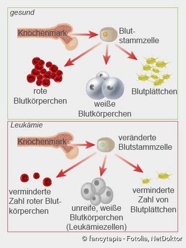 Leukämie Symptome Arten netDoktor de