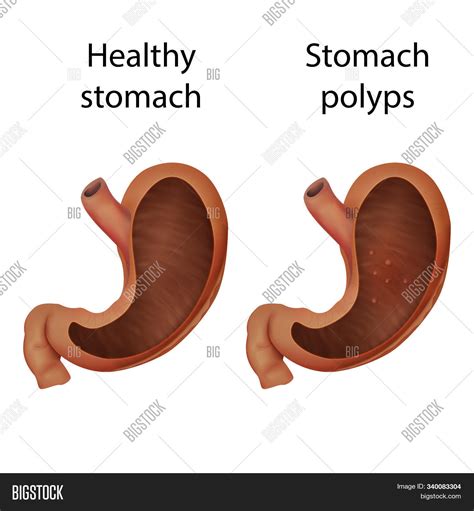 Stomach Polyps Healthy Image & Photo (Free Trial) | Bigstock