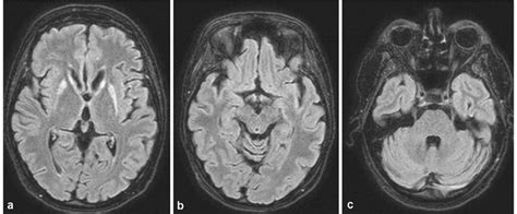 Axial T2 Flair Shows Bilateral Hyperintensities In The Putamen And