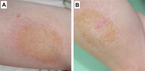 A The Brownish Patch With Yellowish Discoloration Over The Right Download Scientific Diagram