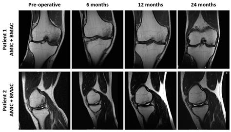 Jcm Free Full Text Autologous Matrix Induced Chondrogenesis Amic