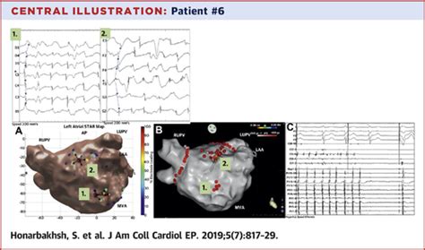 Ablation In Persistent Atrial Fibrillation Using Stochastic Trajectory