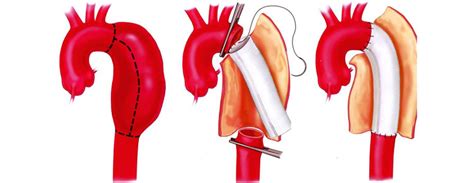 Open surgery treatment of an aortic dissection surgery in chennai