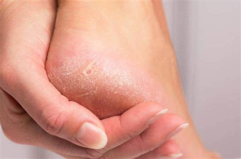 Treatments For Skin Peeling On Toes And Feet Treat N Heal