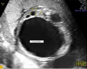 Prenatal Diagnosis Of Megacystis Microcolon Intestinal Hypoperistalsis