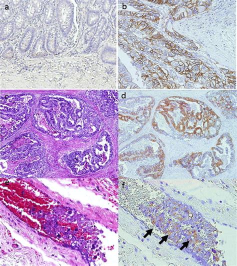 Immunohistochemical Staining Of Gastric Cancer Tissues Using Mouse