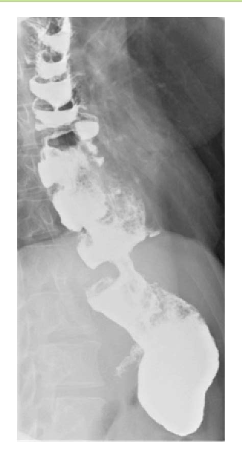 Figure From Surgical Management Of Graft Redundancy After Colon