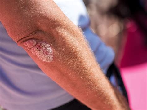 Chronic Plaque Psoriasis Symptoms Treatment And More