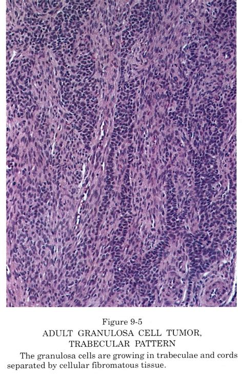 Pathology Outlines Granulosa Cell Tumor Adult