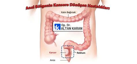 Anal B Lgenin Kansere D N En Hastal Klar