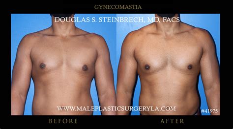 Gynecomastia