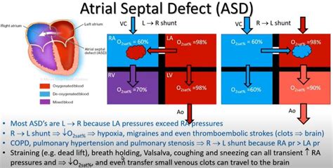 Atrial Septal Defect ASD And Patent Foramen Ovale PFO Fit Test