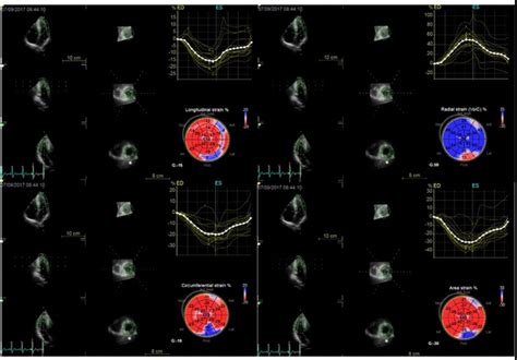 Evaluation Of Left Ventricular Systolic Function In Patients With