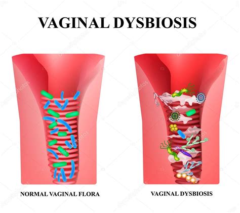 Disbiosis Vaginal Disbacteriosis De La Vagina Vaginitis Candidiasis