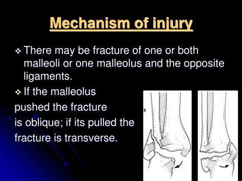 PPT Ankle Fractures POTTS FRACTURE PowerPoint Presentation Free