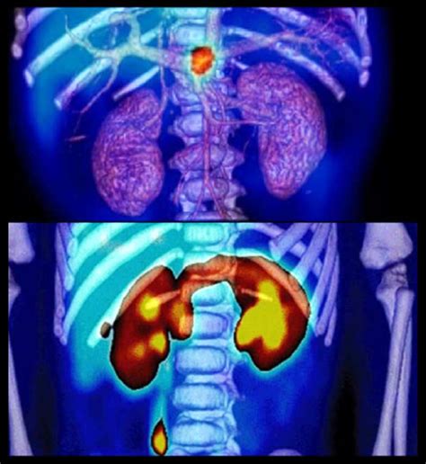 Medicina Nuclear Una técnica de diagnóstico por imagen poco conocida