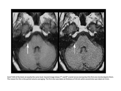 Mri Artifact Radiology Ppt