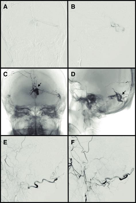 Anteroposterior A And Lateral B Views Of The Left Mma Angiography Download Scientific