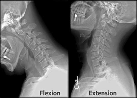 Range of Motion of Cervical Spine | Bone and Spine