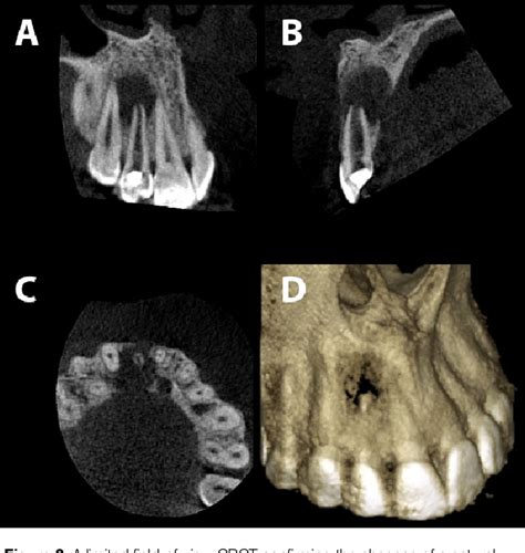 PDF Resolution Of A Large Periapical Lesion In An Immature Maxillary