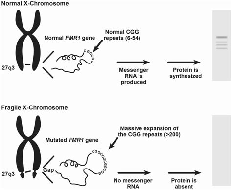 Fragile X Syndrome Causes Inheritance Symptoms Diagnosis And Treatment