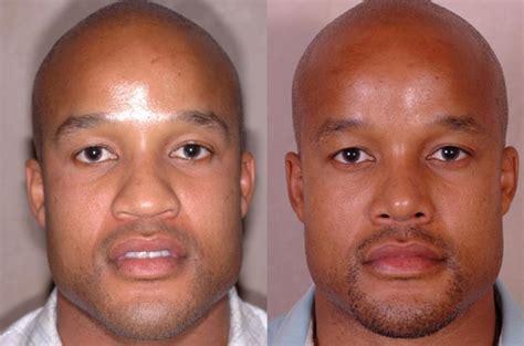 Passion Nose Job Before And After Black Male 2022 My Reff