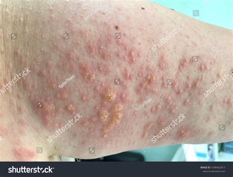 Multiple Erythematous Itchy Papule Clear Vesicles Foto Stock 1548462917 Shutterstock