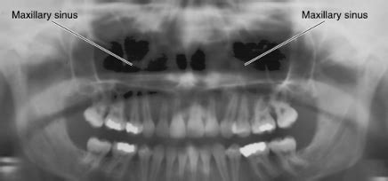 Orofacial Anatomy Maxillary Molars Week 4 Flashcards Quizlet