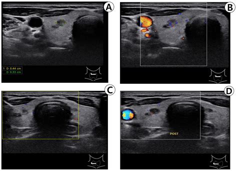 Medicina Free Full Text A Case Of Diffuse Thyroid Hematoma After