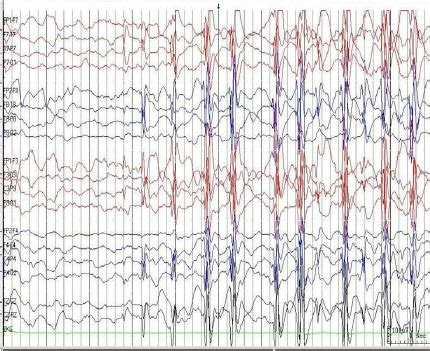 A Long Term Video Eeg Revealed Abnormal Frequent Generalized Spike And