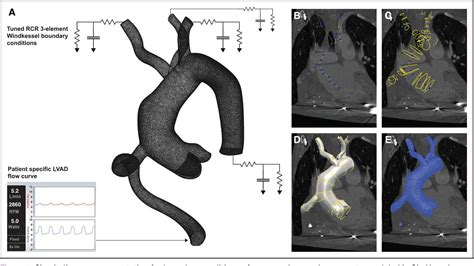 Figure From Patient Specific Computational Fluid Dynamics Reveal