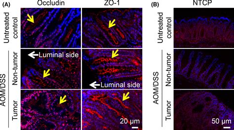 Fluorescence Tumor Imaging By I V Administered Indocyanine Green In A