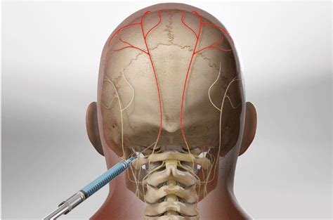 Occipital Nerve Block Florida Surgery Consultants