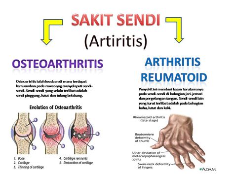 Sakit Sendi Kenali Punca Dan Rawatan Sakit Sendi Tanpa Suntikan