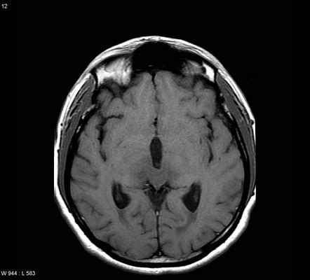 Primary CNS Lymphoma Intraventricular Image Radiopaedia Org