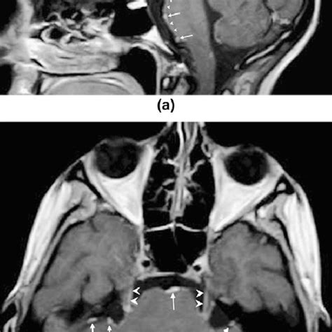 A Contrast Medium Enhanced T1 Weighted Sagittal Image In A Download Scientific Diagram