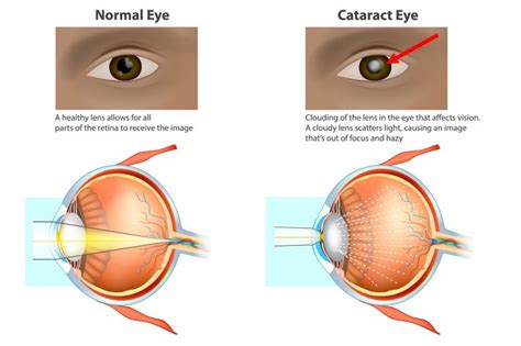 Cataract Surgery Nobel Medical Group