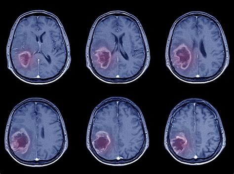Hemorrhagic Stroke Mri