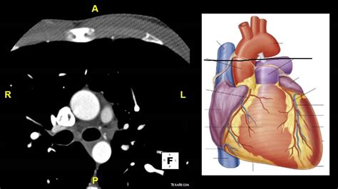 Axial Ct Heart Youtube