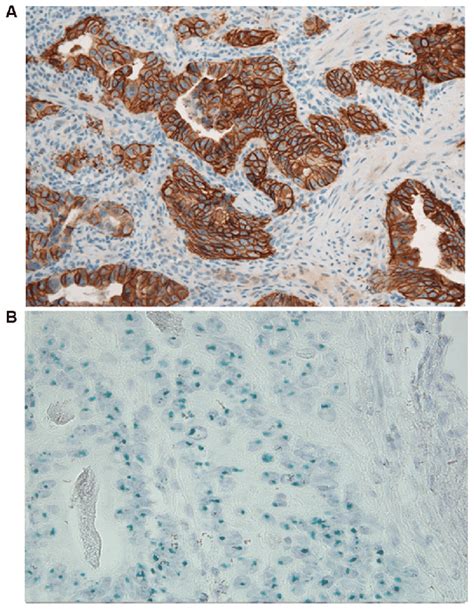 Her Staining Of Gastric Cancer Cells A Her Immunohistochemical