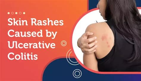 Skin Rashes Caused By Ulcerative Colitis Artofit