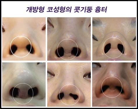 코끝연골묶기 재배치 복코성형후기 코수술 비개방형 효과는대박이었습니다~★ 네이버 블로그